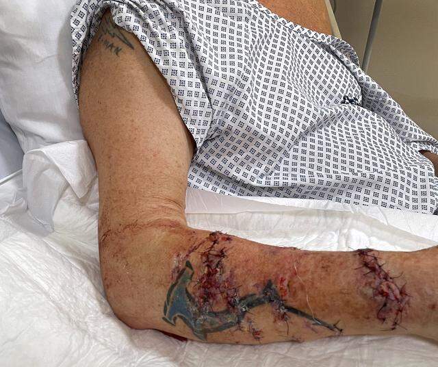 Eric Greager's reparied right arm after he has attacked by a crocodile while swimming off a beach in Mexico.